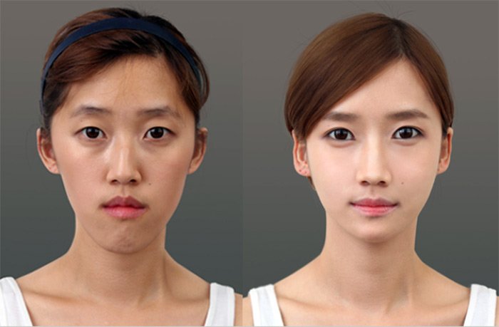 Plastic surgery before and after photos