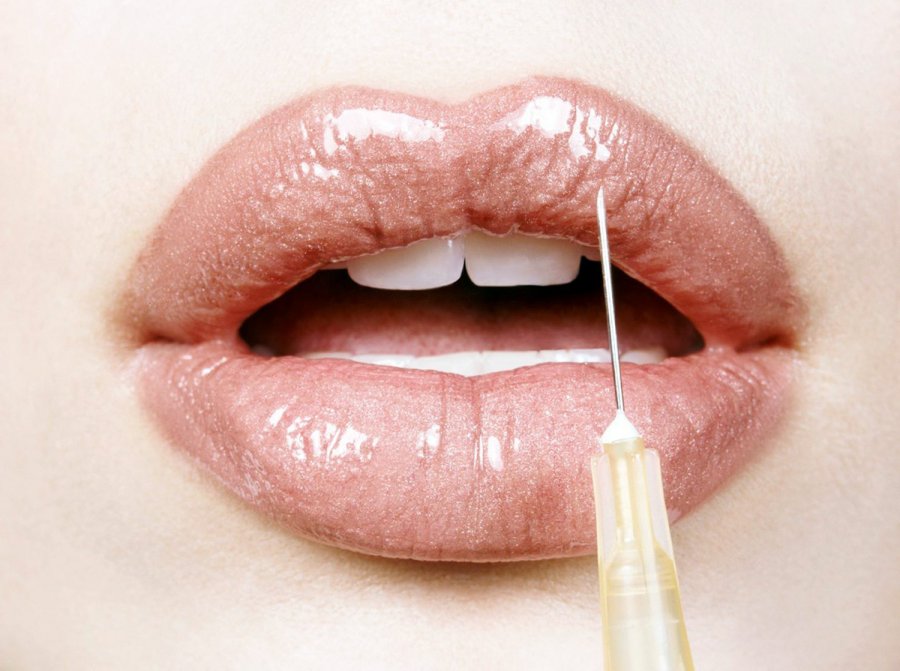 Lip plastics and augmentation