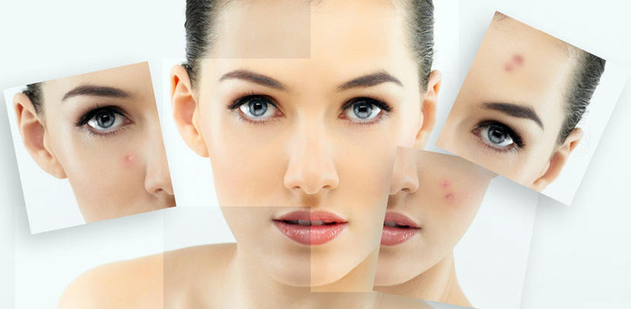 How Skinoren helps treat acne