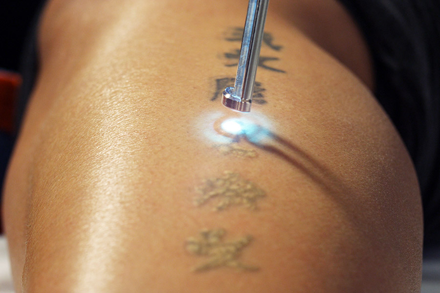 Laser Tattoo Removal