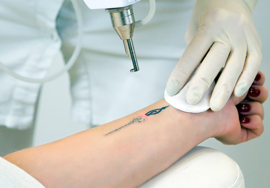 Laser Tattoo Removal