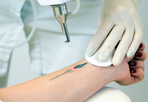 Laser tattoo removal - what to prepare for