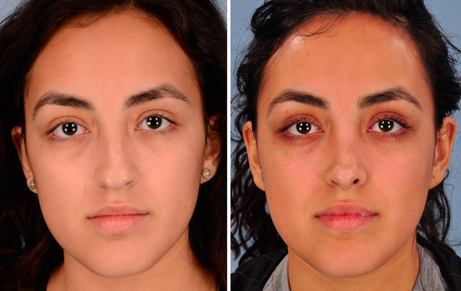 When to do rhinoplasty