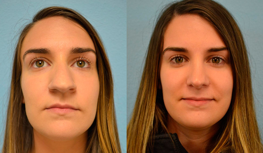 When to do rhinoplasty