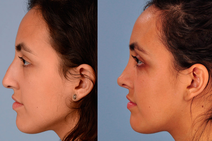 When to do rhinoplasty