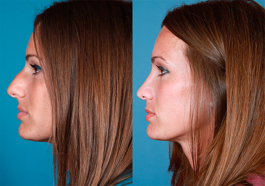 When to do rhinoplasty