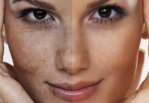 Whitening cosmetics with arbutin for age spots